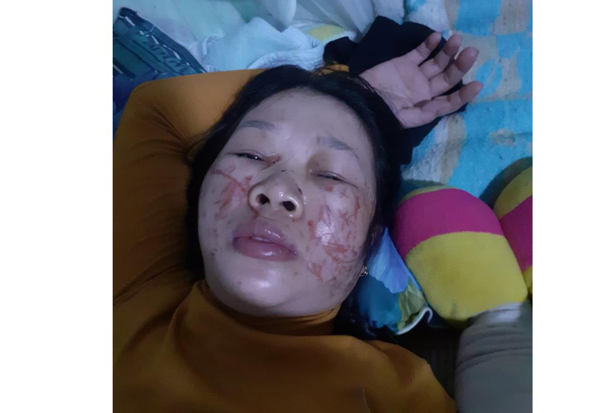 Bà Nguyệt bị đánh với nhiều vết thương chằng chịt trên mặt.