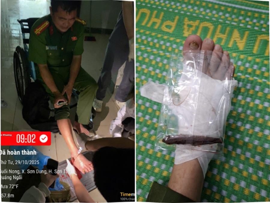 Thượng tá Đinh Quang Tiến bị thanh gỗ đâm xuyên bàn chân khi hỗ trợ người dân. Ảnh: CA