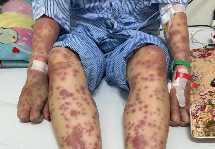 Sau nỗ lực điều trị của các bác sĩ, nữ bệnh nhân đã qua được nguy kịch