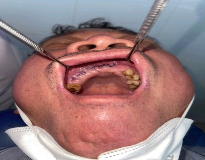 Hình ảnh bệnh nhân sau phẫu thuật cắt xương hàm trên hoạt tử.