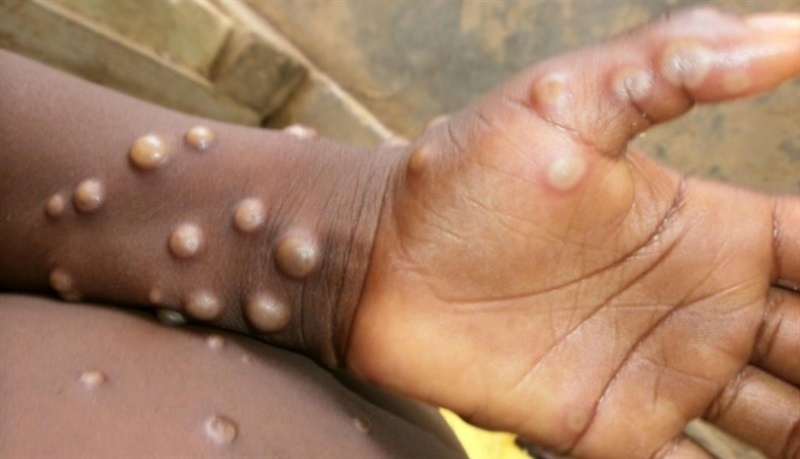 Bệnh đậu mùa khỉ có các triệu chứng ban đầu như sốt cao, sưng hạch bạch huyết và phát ban giống như bệnh thủy đậu.