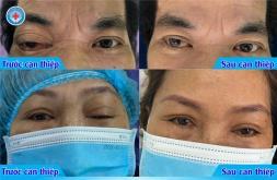 Tránh khỏi nguy cơ mù lòa sau chấn thương sọ não