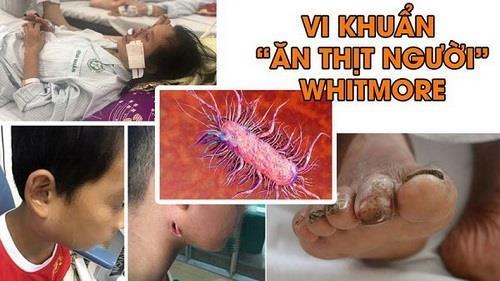 Người phụ nữ ở Quảng Nam tử vong do nhiễm vi khuẩn ăn thịt người