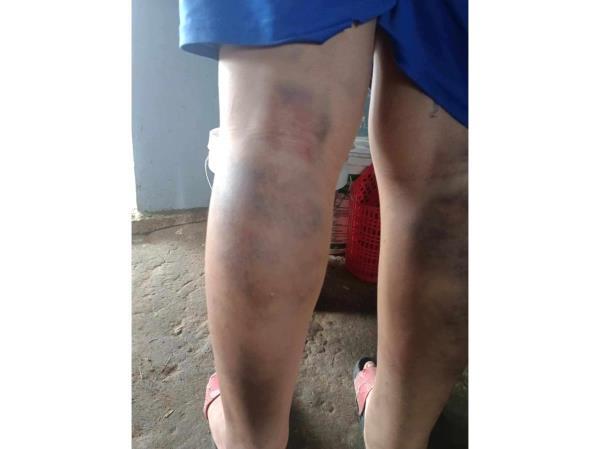 Tạm đình chỉ cô giáo đánh học sinh lớp 6 bầm tím 2 chân