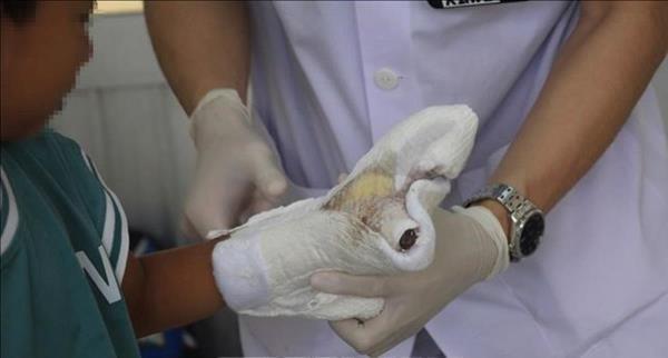 Cảnh báo tình trạng tự chế pháo nổ và gây thương tích ở trẻ em