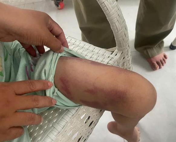 Bắt giam người mẹ và gã dượng hờ bạo hành dã man bé gái 9 tuổi, bắt nhúng lưỡi vào nước sôi