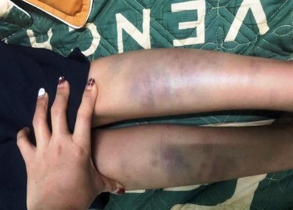 Vụ việc học sinh lớp 1 bị đánh tại trường tiểu học Nguyễn Phan Vinh không cấu thành tội phạm