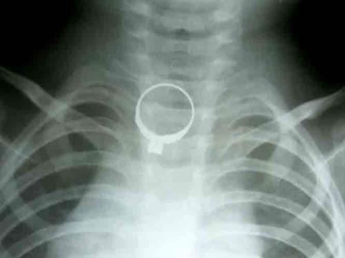 Cứu thành công bệnh nhi nuốt chiếc nhẫn vào thực quản