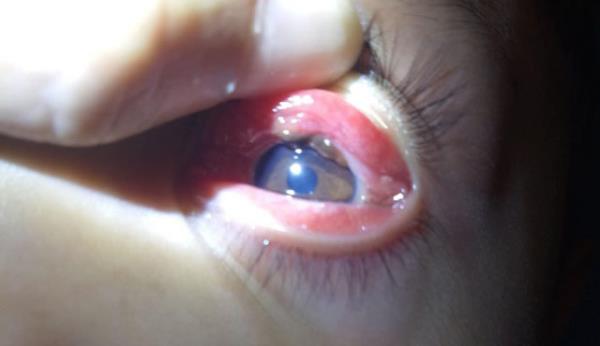 Gắp con vắt trong mắt bé trai 8 tuổi