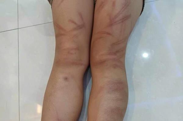 Nhiều trẻ mầm non nghi bị bạn đánh bầm tím cơ thể