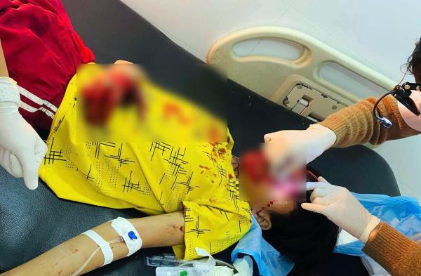 Cấp cứu thành công bé trai bị thương do nổ điện thoại